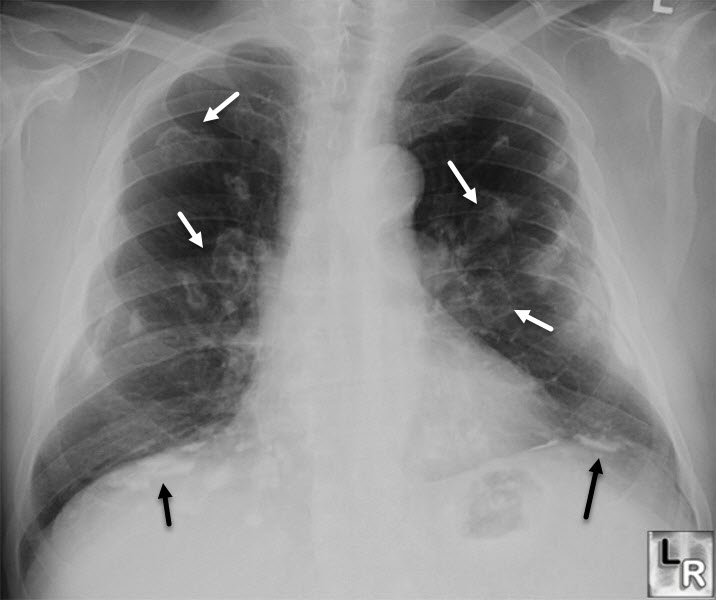 Asbestos-Related Pleural Disease